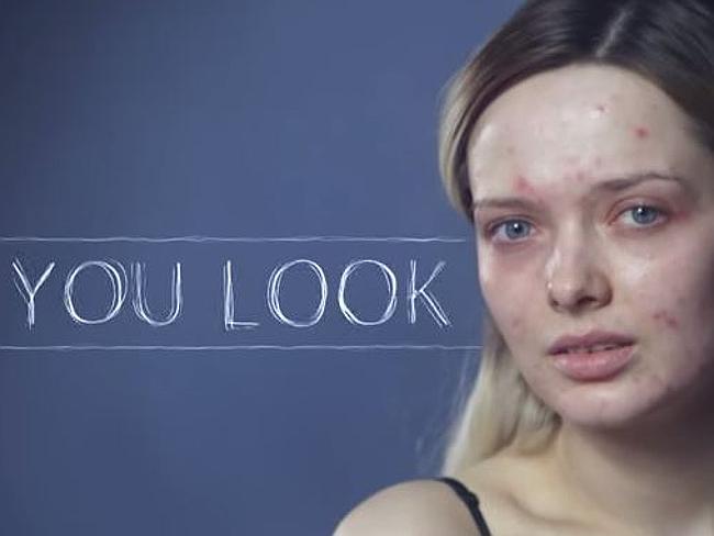 Une blogueuse beauté moquée pour son acné, réalise une vidéo incroyable…