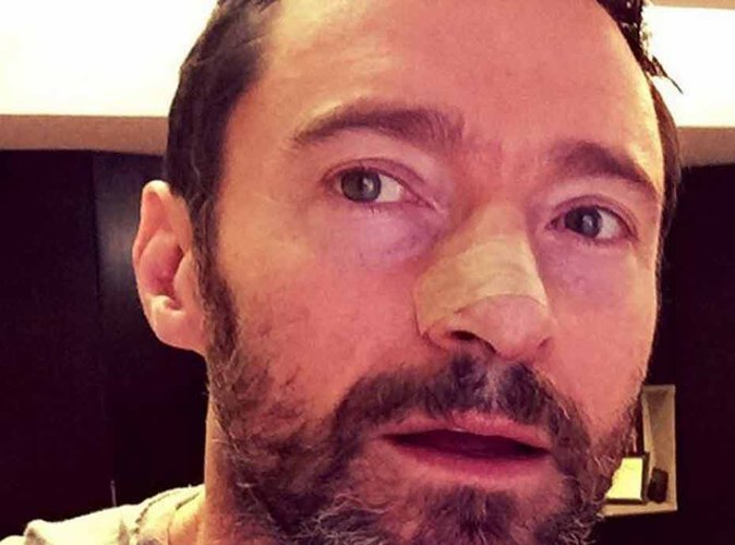Hugh Jackman, opéré pour la 5ème fois d’un cancer !