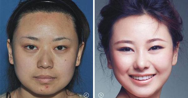 17 chinoises avant et après la chirurgie esthétique !