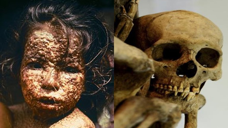 5 MALADIES les plus MORTELLES DE L&rsquo;HISTOIRE !