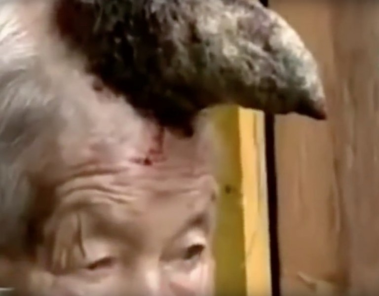 Cette Chinoise a une énorme corne qui pousse sur le front !!