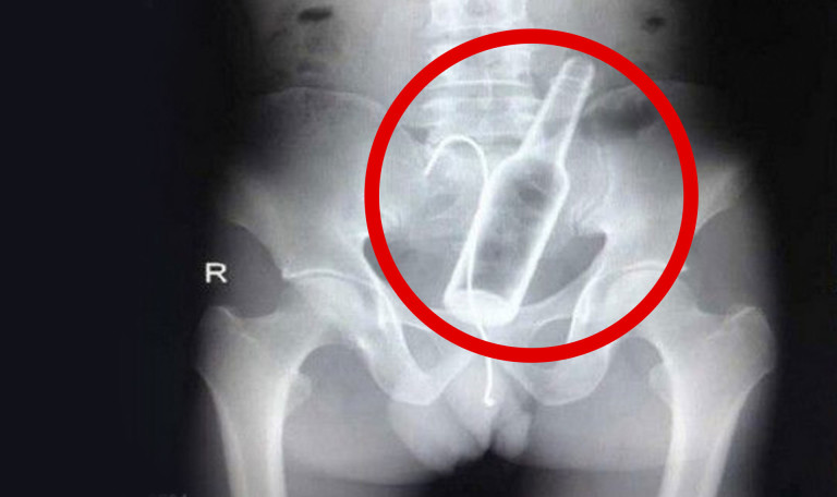 4 OBJETS RETROUVÉS dans le CORPS HUMAIN !