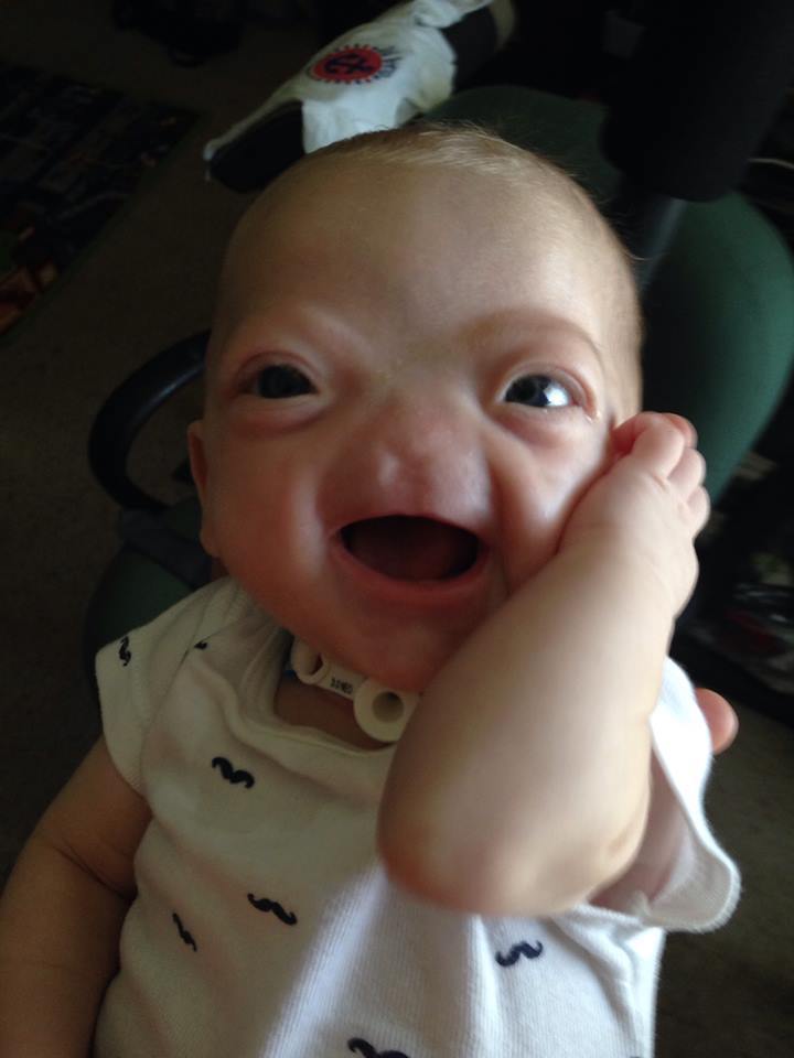 Ce magnifique bébé est né sans nez !