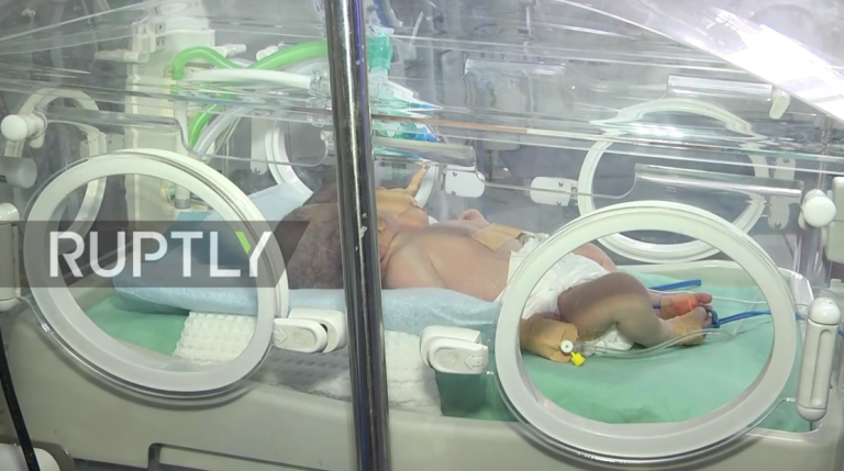 Un bébé à deux têtes est né à Gaza