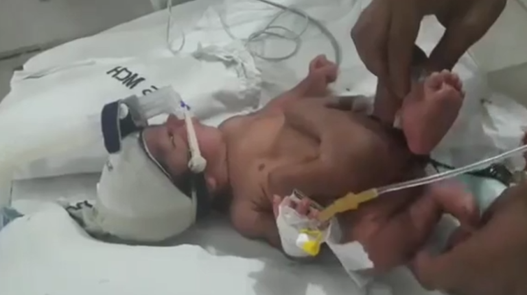 Un enfant naît avec 4 jambes et 2 pénis…