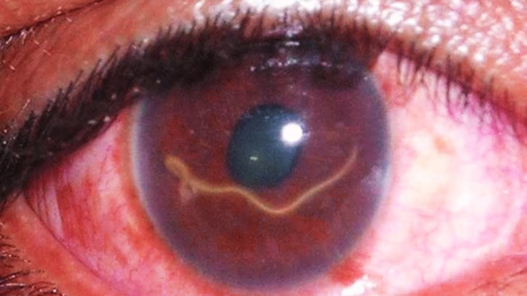 5 HORRIBLES BÊTES VIVANTS DANS LE CORPS HUMAIN !