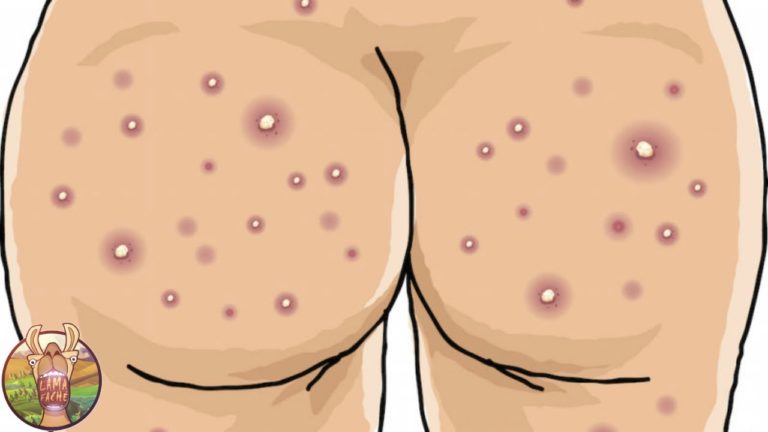 5 CAUSES DE L&rsquo;ACNÉ SUR LE CORPS