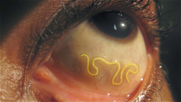 5 CHOSES HORRIBLES TROUVÉES dans un CORPS HUMAIN