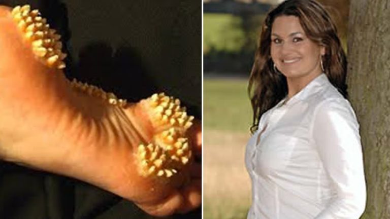 4 Maladies les plus Étranges et Effrayantes