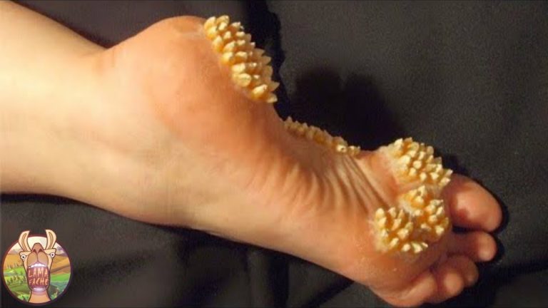 LES 10 MALADIES LES PLUS BIZARRES DU MONDE